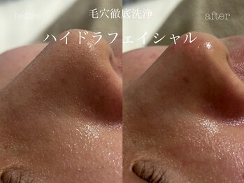 キアラ(CHIARA)/ハイドラフェイシャル