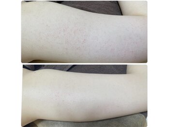 リーフィア(Leafia)/悩み続けたお肌に、、、