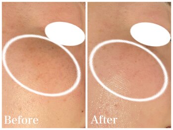 ノア 新宿(Noa)/ハーブピーリング+マシン 6回