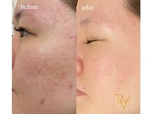 ラヴィス(RAVIS)/プロセル本気の肌質改善！