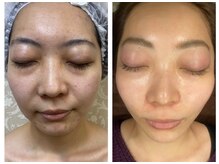 ラトナ(RATNA)/ホワイトハーブ4回