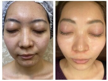 ラトナ(RATNA)/ホワイトハーブ4回