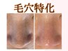 【夏季限定】毛穴洗浄付き/ハーブピーリング　¥21450→