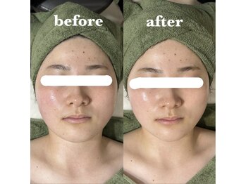 リーフィア(Leafia)/本来のフェイスラインへ◎