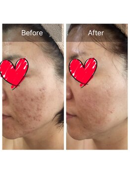 クリニカルエステ(Salon de LOMA reve beaute)/ドクターリセラ素肌改善☆