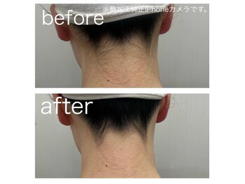 ラクシー 北千住(luxssy)/うなじシェービング