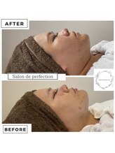 サロン ド パーフェクション(Salon de Perfection)/小顔リフト