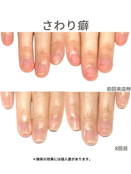 30代/いじり癖/アフター