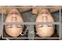 ビーマジック(美magic)の雰囲気（韓国大人気ララピール 育てるピーリング艶感爆誕！色ムラ改善）