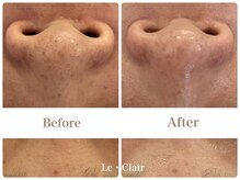スキンセラピーサロン ル クレール(Le Clair)/Before→After