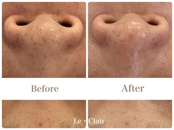 スキンセラピーサロン ル クレール(Le Clair)/Before→After