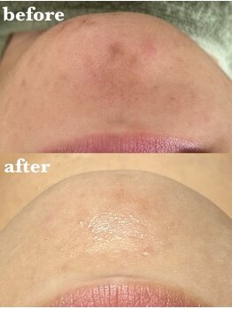 リーフィア(Leafia)/頑固な肌荒れとさようなら!