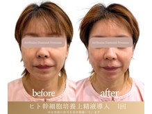 ルソール(Le seul)/驚異のヒト幹細胞培養上清液導入