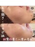 【高濃度ビタミン/開き毛穴ケア】肌質改善ハーブピーリング ¥17050→¥14300