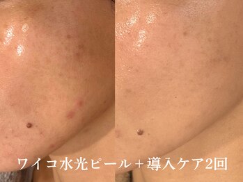 シュリー(Sriii)の写真/毛穴詰まり退治にはピーリング！ハーブピーリング・雪花ピール・ワイコ水光ピール・エンビロン乳酸ピール