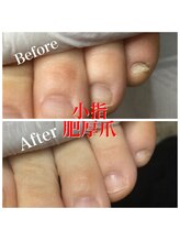 プラスキュア 用賀店(+CURE)/肥厚爪 変形爪 副爪 60分6600～