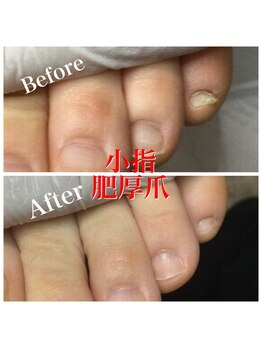 プラスキュア 用賀店(+CURE)/肥厚爪 変形爪 副爪 60分6600~