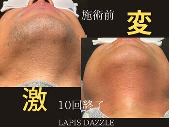 ラピスダズル(LAPIS DAZZLE)/ひげ脱毛☆途中経過(10回終了後)