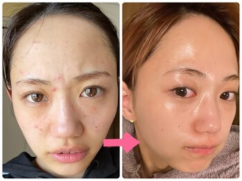 ルリリ(Luriri)/女優肌フェイシャルエステ