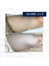 メンズクリア セブンパーク天美店/【メンズクリア】お客様の施術例