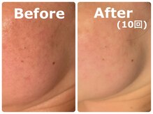 スイ 昭島店(Sui)/ハーブピーリング/シミケア/美白