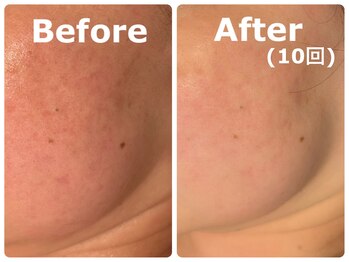 スイ 昭島店(Sui)/ハーブピーリング/シミケア/美白