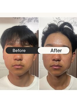 リラクゼーションサロン ラキ(laki)/ハイピールイントゥ/ピーリング