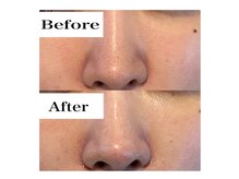 【透明感美肌】ハーブピーリング&毛穴洗浄でうるツヤ透明肌へ☆