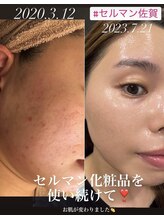 セルフラブ(Self love)/セルマンエステで肌質改善
