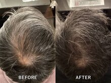 アンテイン(anthein)/先進養毛プログラム