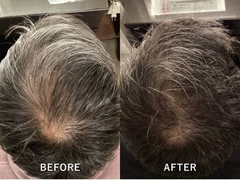 アンテイン(anthein)/先進養毛プログラム