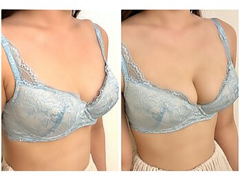 美人バスト 豊橋店/バストアップ症例【バストケア】