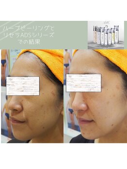 マリー エクラン/30代女性ニキビケア・シミ改善