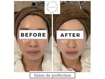 サロン ド パーフェクション(Salon de Perfection)/小顔リフト