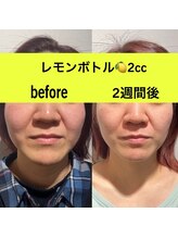 ララチッタ(L'la citta)/レモンボトル2cc