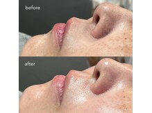 ラウネ(Laune)の雰囲気（フェイスWAXでワントーンアップで艶肌に＊毛穴汚れなどにも！）