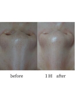 アップルミント/＜フェイシャル＞before・after