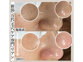 リアン(Riant)/毛穴ケアコース
