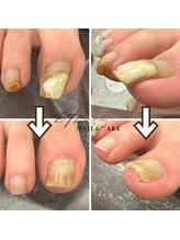 ビーティーバニ(B.tBani)/巻き爪