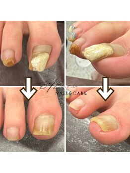 ビーティーバニ(B.tBani)/巻き爪