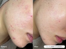 フォンビューティー(fon beauty)/1回の施術/2週間での効果