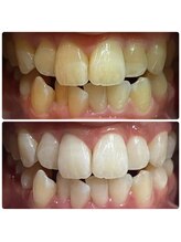 ルフレ(Reflet)/ビフォーアフター