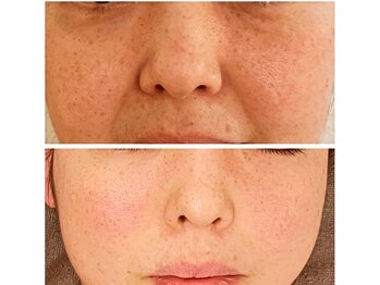 ジーニー(Genie)/リベル　ハーブピーリング