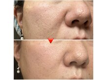 エミナル(eminal)/ビフォー/アフター /毛穴/梅田