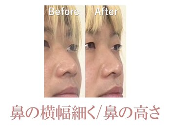 ラプリ 銀座店(Raplit)/隆鼻＋輪郭矯正40分10回