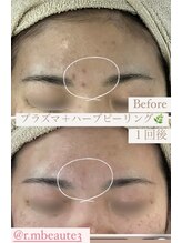 アールエム ボーテ(RM beaute')/プラズマ＋ハーブピーリング