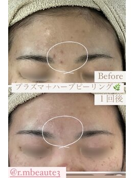 アールエム ボーテ(RM beaute')/プラズマ＋ハーブピーリング
