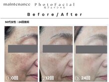 アトリエ デザイン ビューティー(atelier design beauty)の雰囲気（【光フェイシャル】土台から整えるメンテナンスメニュー♪）