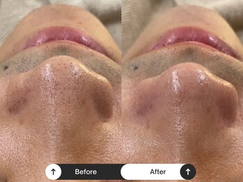 リジュ(Reje)/毛穴洗浄によるケア