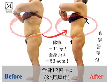 マリス(MARISS)/全身痩身【ハイパーナイフ痩身】